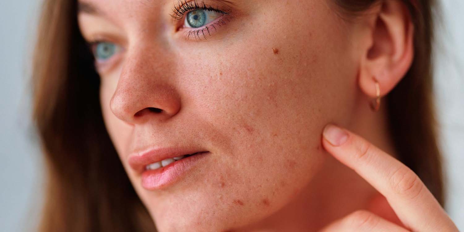 Deretan Skincare untuk Hilangkan Dark Spot Bekas Jerawat